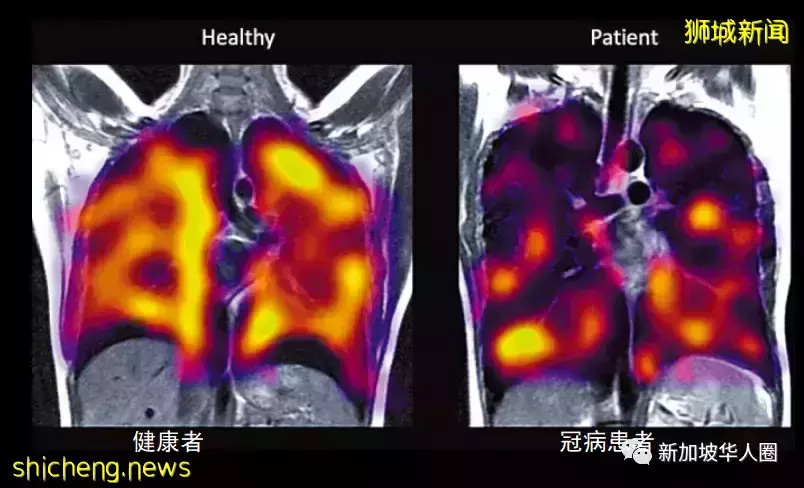 新加坡多人感染后重症病逝,长期后遗症不会完全消除