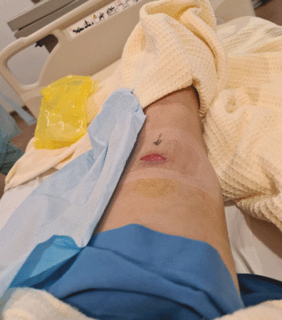 伤口需常换洗 童缤毓怕太痛 希望肉快长回来