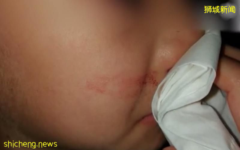 过去两天流过鼻血 孩童不宜做ART检测