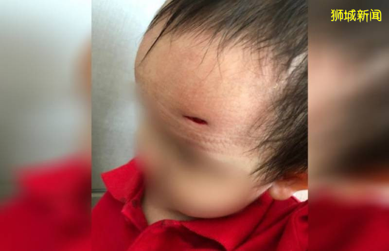 网友：一岁半的女儿在新加坡幼儿园受伤缝针，却没有人能说清楚