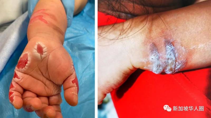 新加坡17個月寶寶手被女傭放鍋裏煮,皮開肉綻!判坐牢14個月